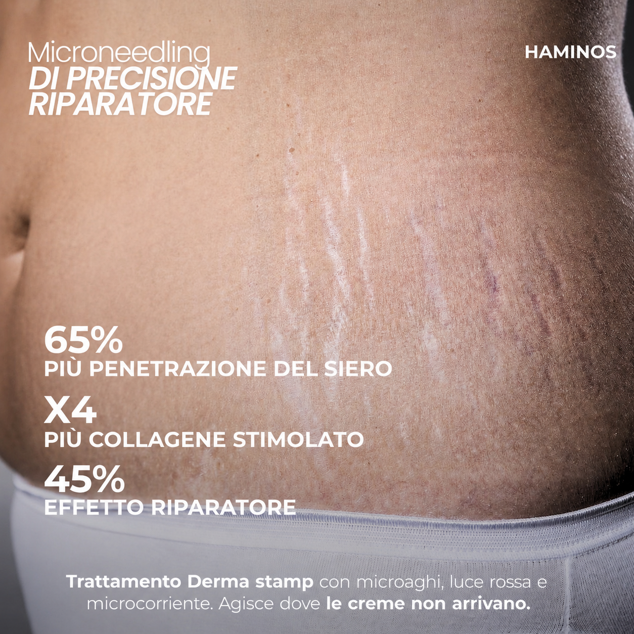 Trattamento antismagliature con derma stamp