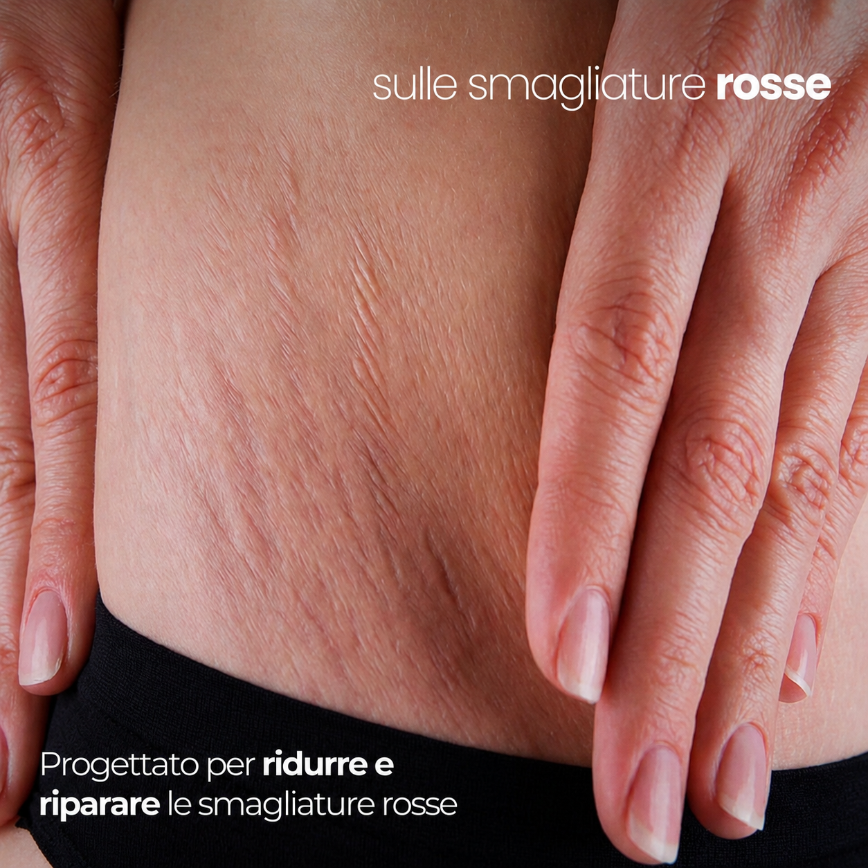 Trattamento antismagliature con derma stamp