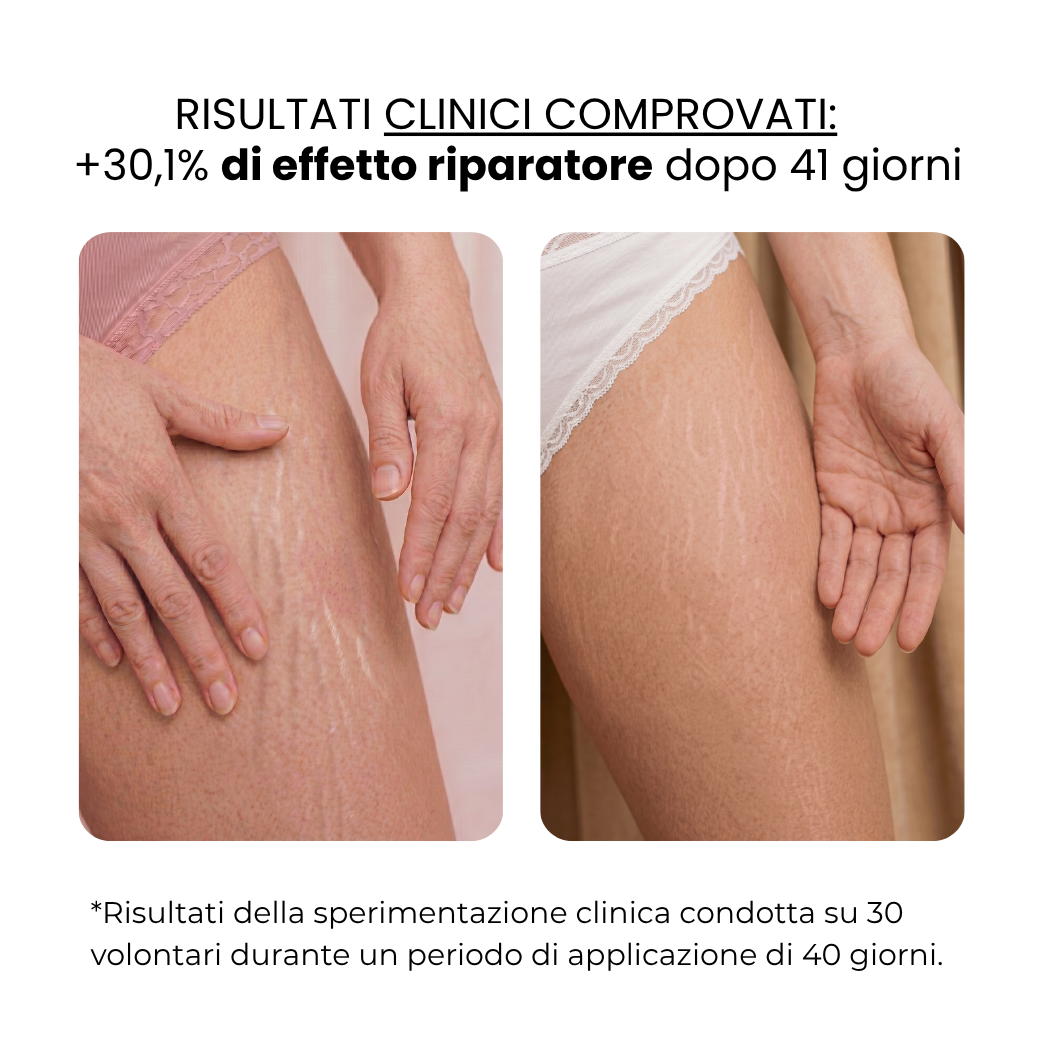 Trattamento Anti Smagliature | HAMINOS®